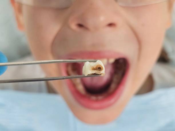 Best Emergency Dental Care for Broken or Chipped Teeth in North Vernon, IN