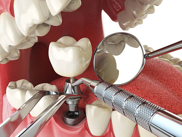Best Emergency Treatment for Dental Infections or Abscesses in North Vernon, IN